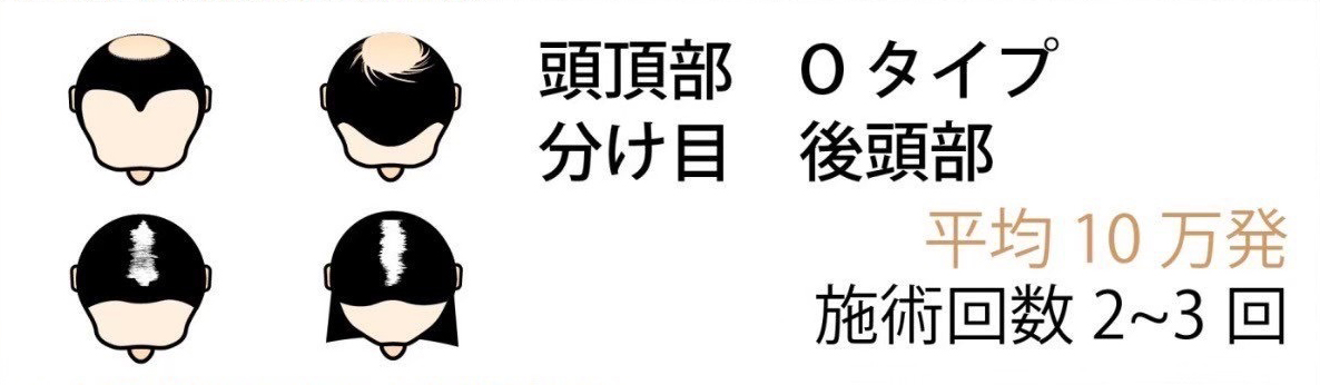 頭頂部 Oタイプ 分け目 後頭部 平均20万発 施術回数 2~3回