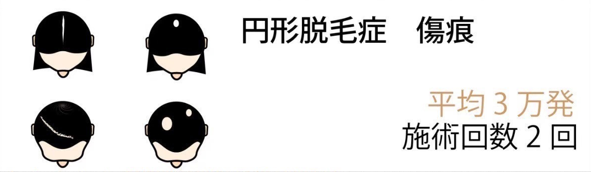 円形脱毛症 傷痕 平均5万発 施術回数 1~2回